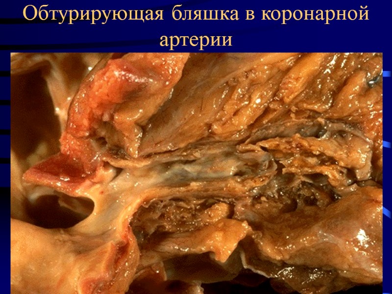 Обтурирующая бляшка в коронарной артерии